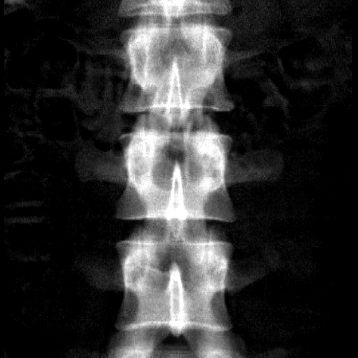 DXA of spine